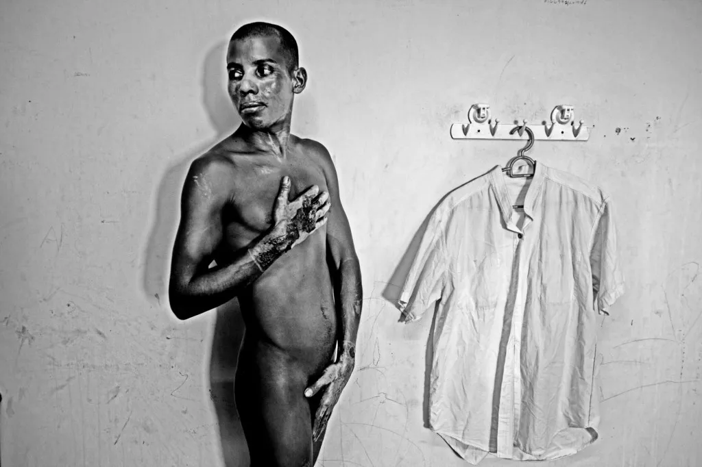 Sheikh Mohammad came to Malaysia a year ago and took a job in a tire recycling factory. As a result of an accident in the factory in July 2012, 60 percent suffered from third degree burns. He did not receive any money for his treatment of for compensation. This photograph was taken after a month of the accident.